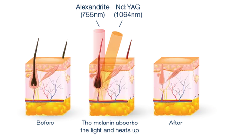 "Pau Laser" gallery image 5 of 6