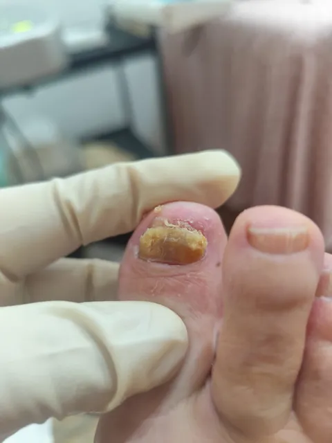 Imagem 10 de 14 na galeria de "Pabreu Pedicure Medical - Podóloga(Brasil)"
