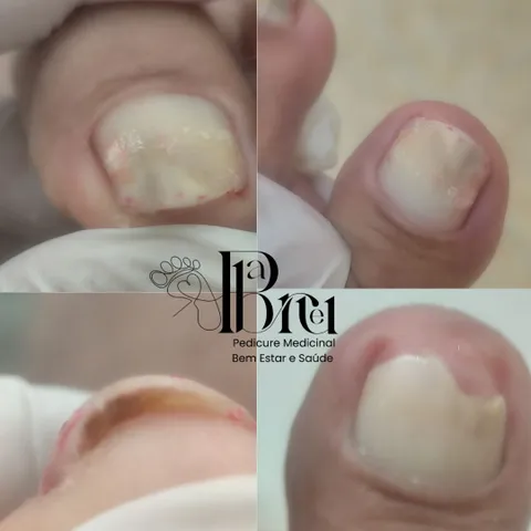 Imagem 1 de 14 na galeria de "Pabreu Pedicure Medical - Podóloga(Brasil)"