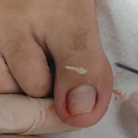 Imagem 3 de 14 na galeria de "Pabreu Pedicure Medical - Podóloga(Brasil)"