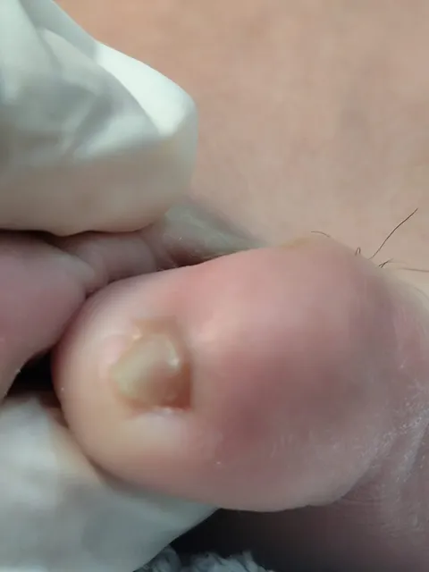 Imagem 9 de 14 na galeria de "Pabreu Pedicure Medical - Podóloga(Brasil)"