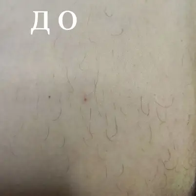 Студія електроепіляції EPIL.KO photo 2