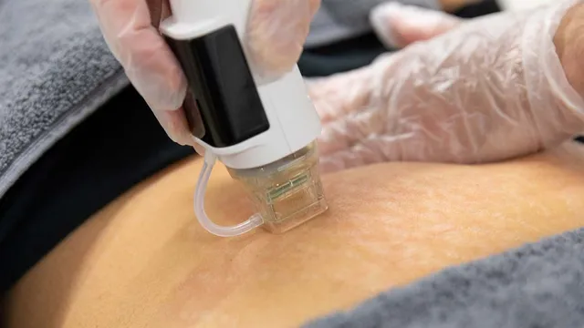 Radiofrecventa Corporala Fractionata