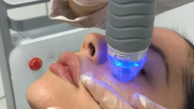 Tratament Radiofrecvență Fracționată