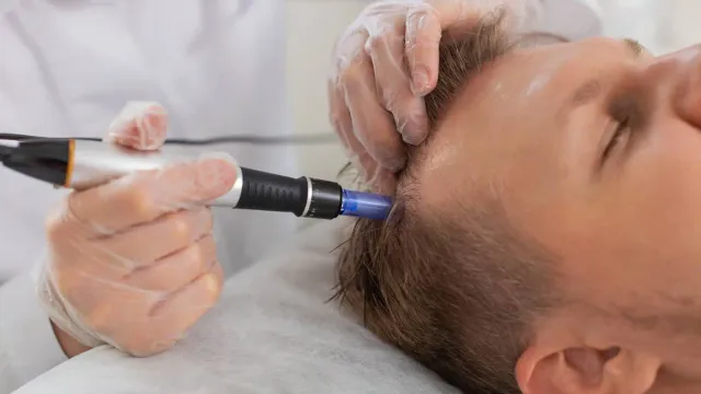 Microneedling Scalp cu Exozomi
