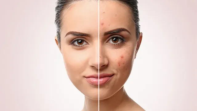 Tratament anti acneic