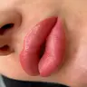 Увеличение губ