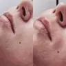 Шугаринг: Верхня губа (вусики)