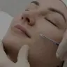 Nefertiti Lift (Platisma, Hals)