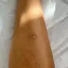 MICRONEEDLING FÜR DEN KÖRPER