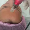 Фракційна мезотерапія