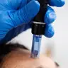 Фракционная (неинъекционная) мезотерапия, 1 зона