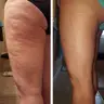Вакуумно роликовий масаж
