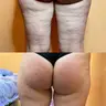 КУРС Вакуумно роликовий масаж,1 процедура