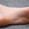 Зачистка мозолів, натоптишів