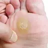 Мозоль