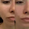 Бланшинг Belotero Soft