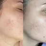 Біорепарація Rejuran S