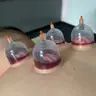 Хіджама мокра + Масаж спини