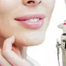 *Лазерна подвійна шліфовка щок Fotona Deep Polish