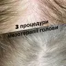 Фракційна мезотерапія голови