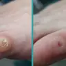 Зачистка мозоля