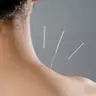 Голкорефлексотерапія