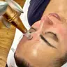 Microneedling