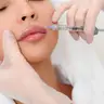 Збільшення губ Juvederm Smile