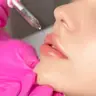 Губа 1 зона ботокс
