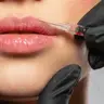 Збільшення губ Saypha Filler