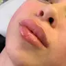 Контурна пластика Губ