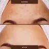 Post Acne Scar Treatment Protocol