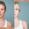 Depigmentation Treatment