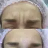 Ботокс 2 зоны