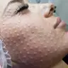 Биоревитализация