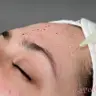 Мезотерапія обличчя