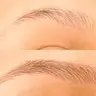 Brow Lifting