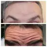 Ботокс Мужчины