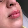Увеличение губ (натуральный эффект)