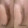 Лазерне видалення брів