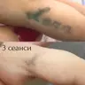 Лазерне видалення тату