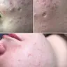 Комбінована чистка обличчя
