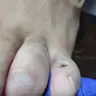 Мозоль
