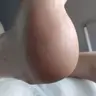 Медичний педикюр