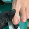 Зачистка оніхолізису: : : : : : : : : : : : : : : : : : stripping onycholysis