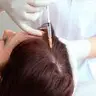 Мезотерапія шкіри голови