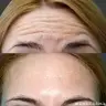 Ботокс Лоб