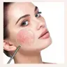 Лазерне лікування куперозу та розацеа Fotona Rosacea®