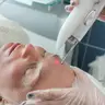 Лазерне глибоке омолодження обличчя Fotona